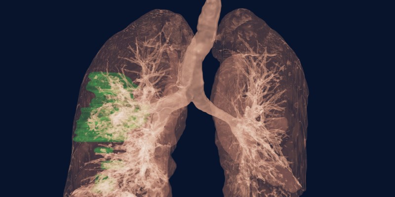 Nvidia's Clara AI for COVID-19 diagnosis from CT scans