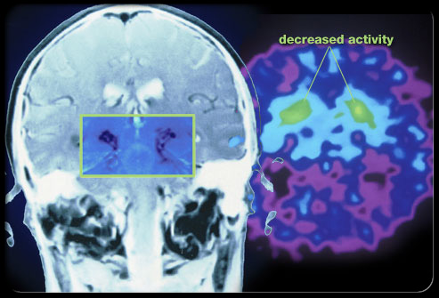 Areas of the brain affected by Parkinson's Disease